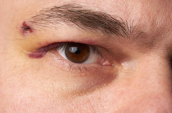 Close View Bruise Eye Face Man Hematoma — Stock Photo, Image