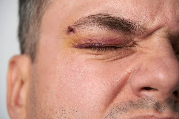 Vista Perto Uma Contusão Perto Olho Rosto Homem Com Hematoma — Fotografia de Stock