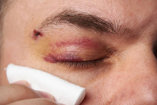 Vista Cercana Moretón Cerca Del Ojo Cara Hombre Con Hematoma — Foto de Stock