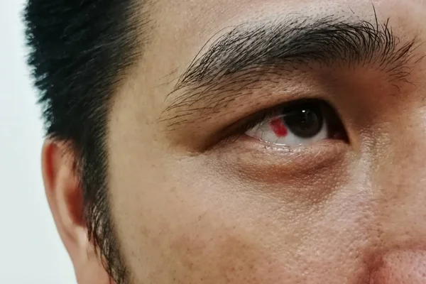 Rotes blutunterlaufenes rechtes Auge — Stockfoto
