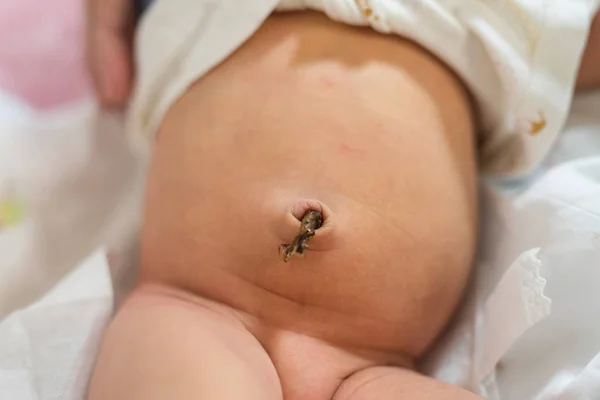 Ξηρό ομφάλιο λώρο του νεογνού μωρού — Φωτογραφία Αρχείου