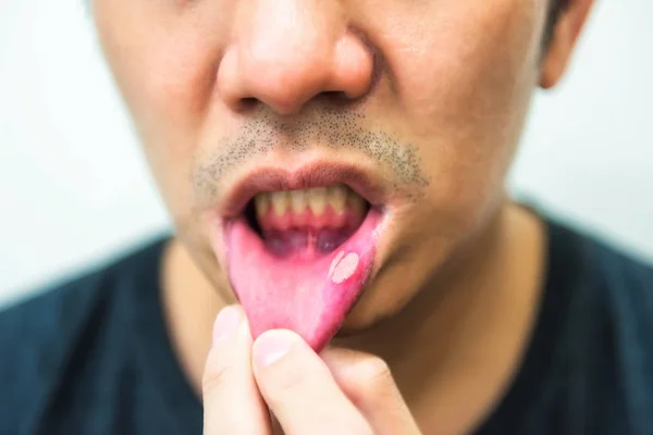 Painful ulcer of ugly man mouth — Stock Photo, Image