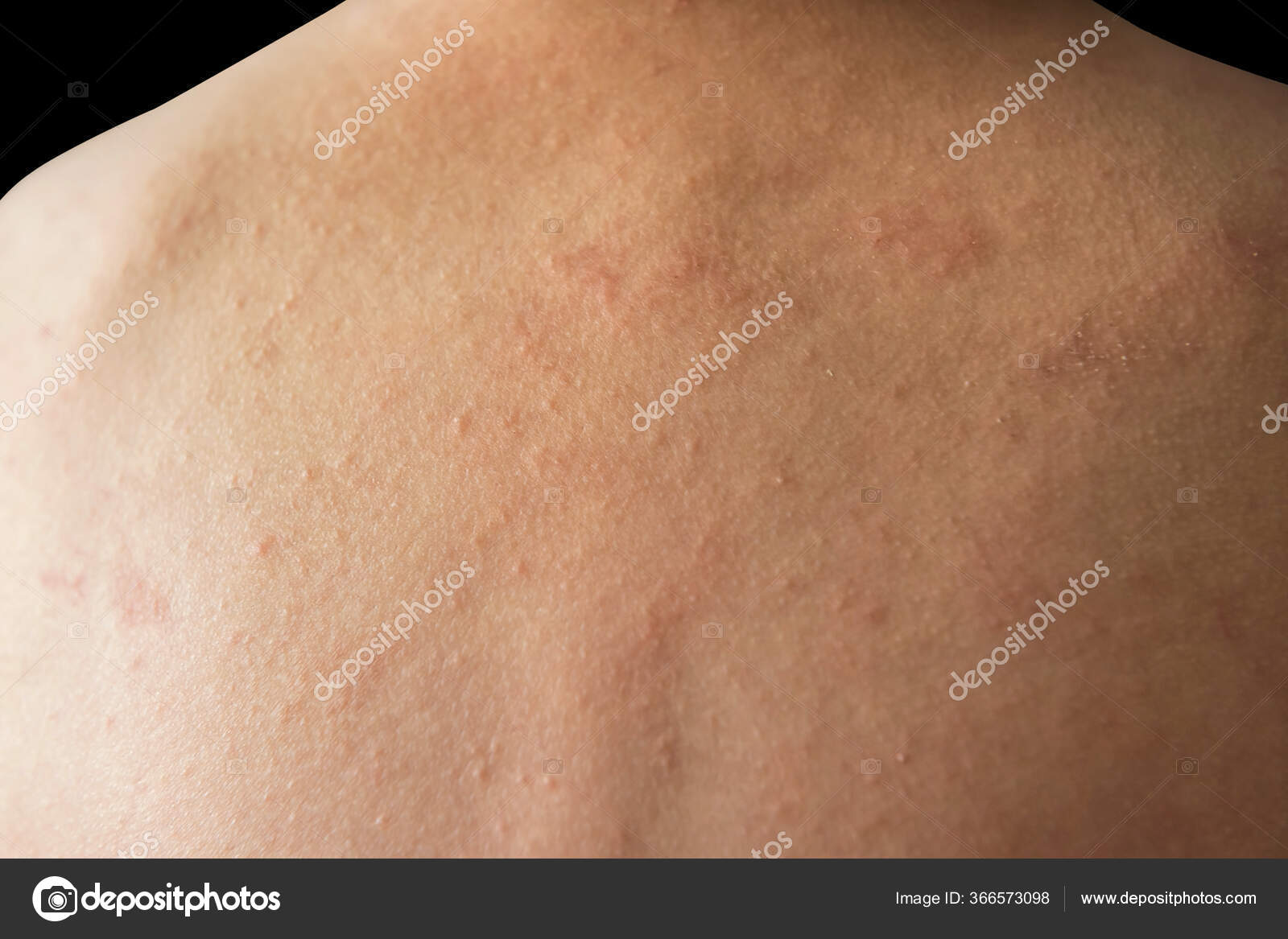 Closeup Kid Back Eczema Atopic Dermatitis Skin Isolated Black Background Stock Photo By C Blanscape Closeup Kid Back Eczema Atopic Dermatitis Skin Isolated Black Background Stock Photo By C Blanscape