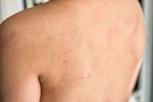 Primer Plano Chico Vuelta Con Eczema Piel Dermatitis Atópica Alergia —  Fotos de Stock