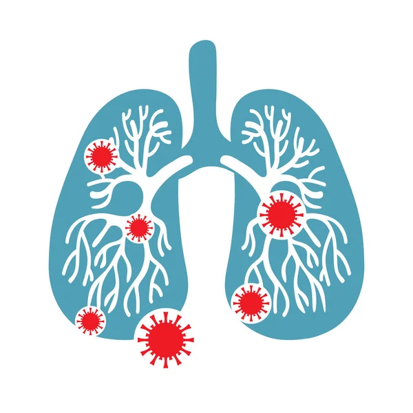 Coronavirus in Cina. Romanzo coronavirus 2019-nCoV. Quarantena virale. Sindrome respiratoria MERS-Cov Medio Oriente. Polmoni umani infettati dal virus. Sistema respiratorio. Malattia all'interno di una persona . — Vettoriale Stock