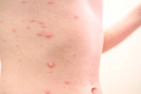 Pelle infantile infetta da varicella — Foto Stock