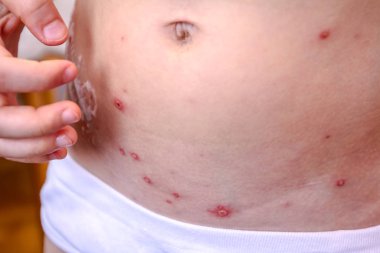 Varicella virüsüne karşı terapi, kızayıcıdır, tavuk çiçeği,