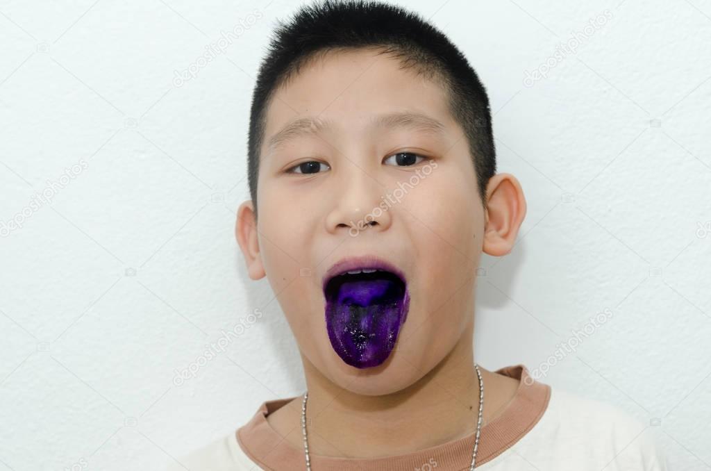 Asian boy showing his purple tongue, he have a mouth ulcer