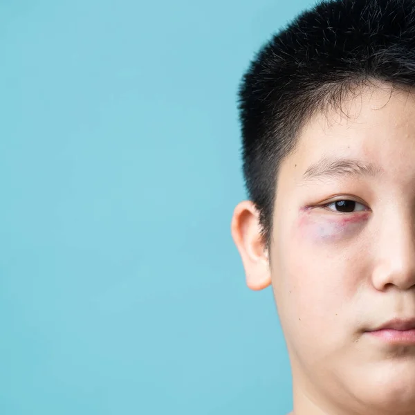 The eye of Asian preteen boy  with bruising beneath the eye. Domestic violence and bully concept with copy space on blue.