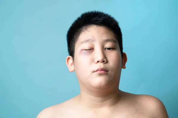 The eye of Asian preteen boy  with bruising beneath the eye. Domestic violence and bully concept with copy space on blue.