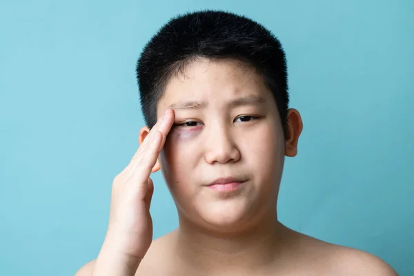 Eye Asian Preteen Boy Bruising Eye Domestic Violence Bully Concept — Stock Photo, Image