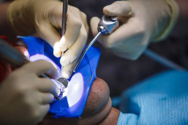 Tedavi ve protez sürecinde lastik eldivenlerin içindeki dişçi elleri. Diş aletleriyle doktor eli..