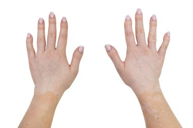 Genç beyaz bir kadının elinin dış kısımlarında vitiligo hastalığından lekeler var. Kırpma yolu olan beyaz bir arka planda izole edilmiş..