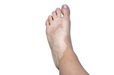 Sol ayağında vitiligo hastalığından lekeler var. Beyaz bir arka planda, kırpma yolu olan beyaz bir kadın..