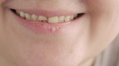 Ön dişi kırılmış ve dinlenmemiş bir kadın ağzı..