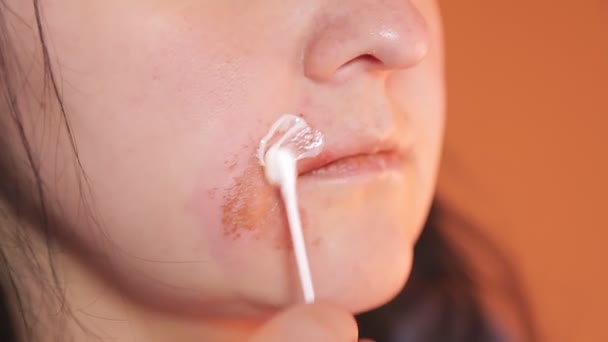 Mano femenina lubrica una quemadura real en la cara con ungüento — Vídeo de stock