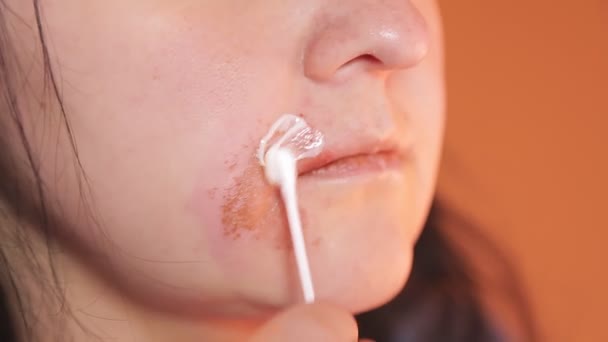 Main féminine lubrifie une vraie brûlure sur le visage avec de la pommade — Video