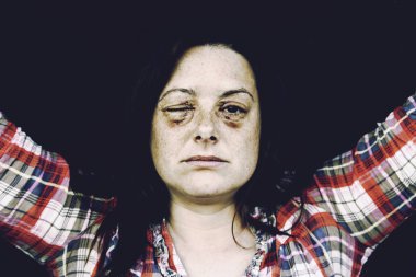 Çürük gözlü kadın