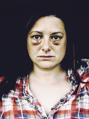 Çürük gözlü kadın