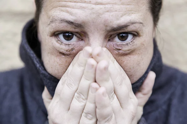 Vrouw met gekneusd ogen — Stockfoto