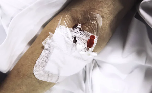 病院の患者の腕の中で静脈内注射 健康と医療 — ストック写真