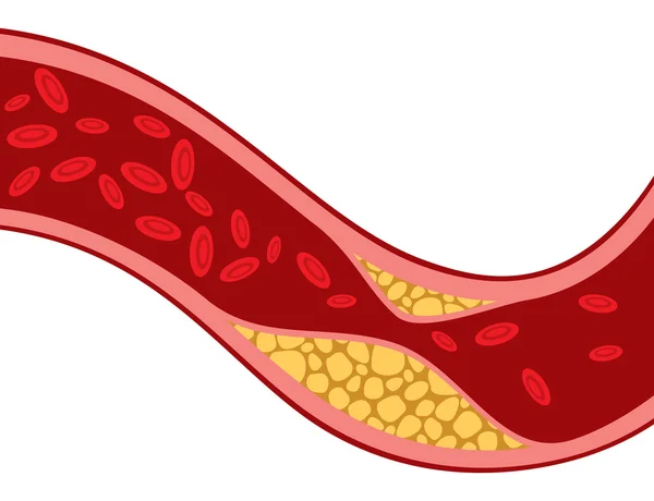 Arteria bloqueada con colesterol — Vector de stock