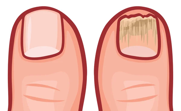 健康和真菌感染的指甲 — 图库矢量图片