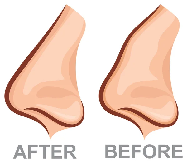 Előtt és után (plasztikai sebészet vektoros illusztráció orrplasztika az orr) — Stock Vector