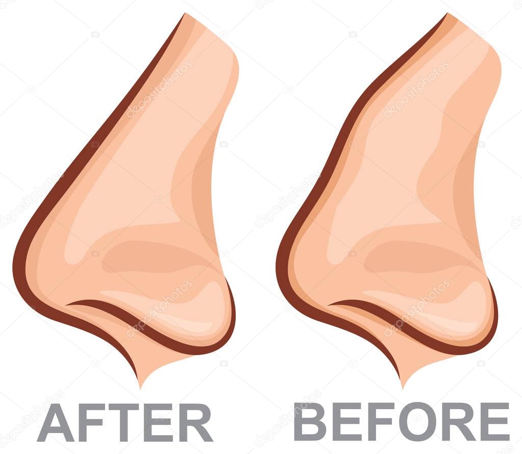 nose before and after rhinoplasty (plastic surgery vector illustration)
