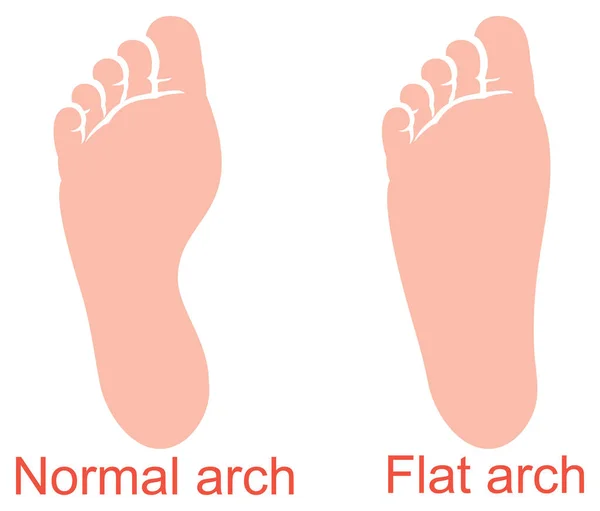 Анатомия человека - плоская и нормальная дуговая векторная иллюстрация — стоковый вектор