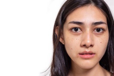 Asian woman gets freckles, blemish, pimple and dull skin on her face. Attractive beautiful Asia woman get eye dark circles, She get no makeup on face. She look unhappy. isolated on white, copy space clipart