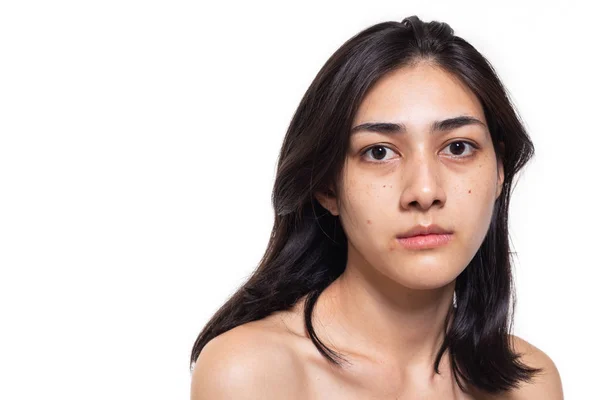 Sproeten Vlekken Puistjes Acne Een Doffe Huid Haar Prachtige Aziatische — Stockfoto