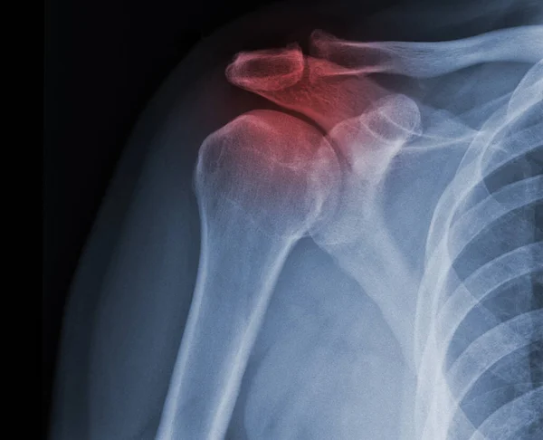 Ray Shoulder Radiograph Show State Injur — Stock Photo, Image