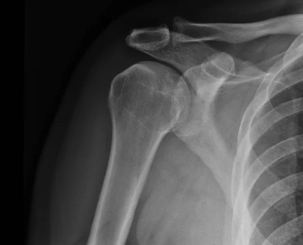 Röntgen Schulterröntgenaufnahme Zeigt Zustand Der Verletzung — Stockfoto