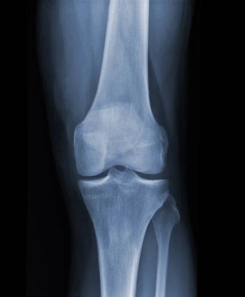 Ray Knee Radiograph Show State Injury — Stock Photo, Image