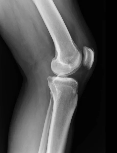 Ray Knee Radiograph Show State Injury — Stock Photo, Image