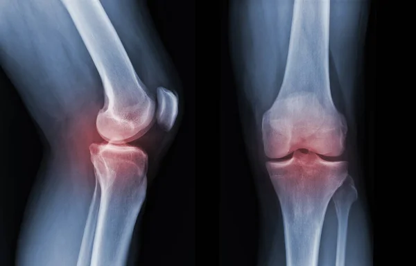 Ray Knee Radiograph Show State Injury — Stock Photo, Image