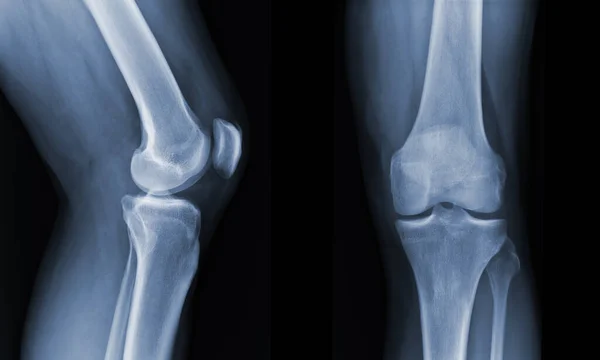 損傷の状態を示すX線膝放射線グラフ — ストック写真