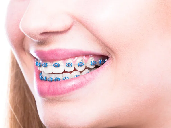 Kobieta pokazując zęby z szelkami — Zdjęcie stockowe
