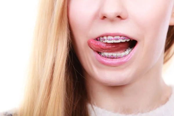 Happy woman showing her braces on teeth — Stock Photo, Image