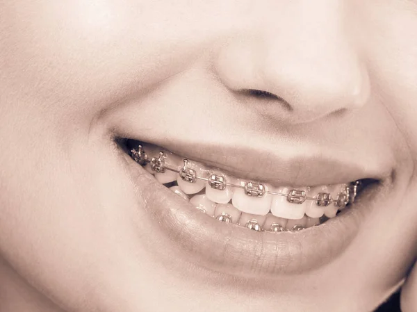 Woman showing her teeth with braces — Stock Photo, Image