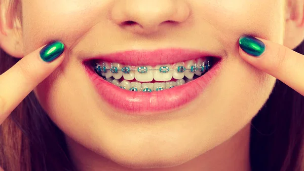 Woman showing her teeth with braces — Stock Photo, Image