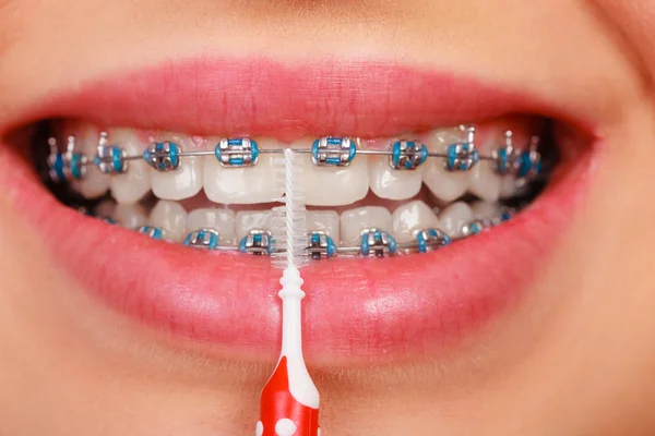 Woman smiling cleaning teeth with braces — Stock Photo, Image