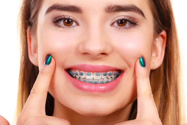 Mujer sonriendo mostrando dientes con aparatos ortopédicos — Foto de Stock
