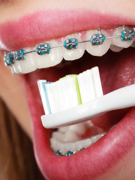 Žena čištění zubů s rovnátkama pomocí štětce — Stock fotografie