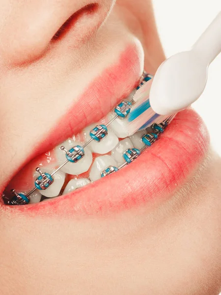 Woman smiling cleaning teeth with braces — Stock Photo, Image