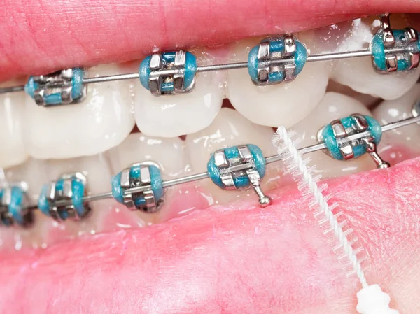 Woman brushing teeth with braces using brush — Stock Photo, Image