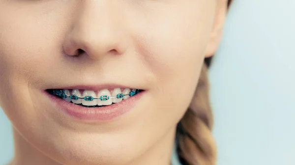 Vrouw toont haar tanden met bretels — Stockfoto