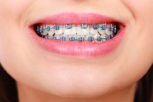 Крупный план женских зубов с брекетами — стоковое фото