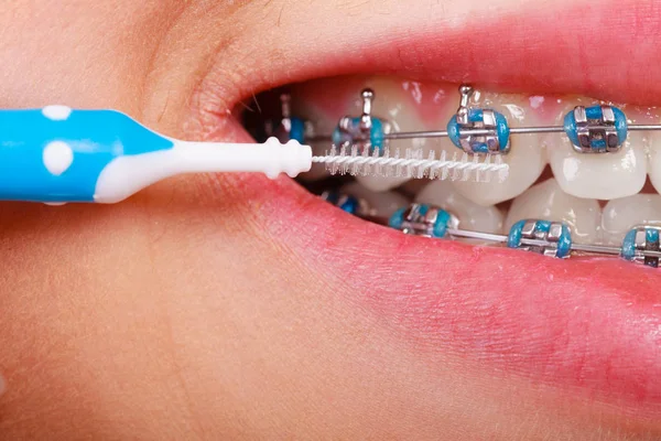 Mujer cepillándose los dientes con aparatos ortopédicos usando cepillo —  Fotos de Stock